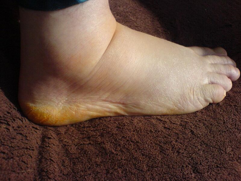 File:Geschwollener menschlicher Fuß.JPG