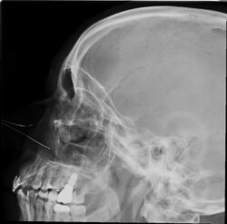 Paranasal sinuses radiograph lateral.jpg