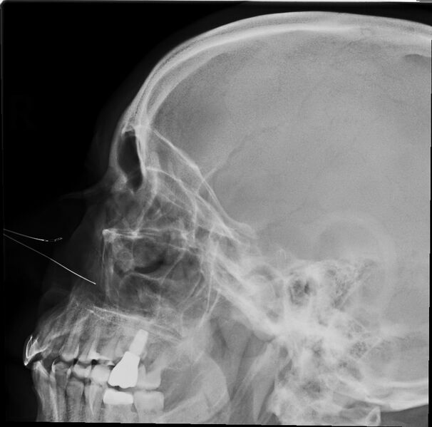 File:Paranasal sinuses radiograph lateral.jpg