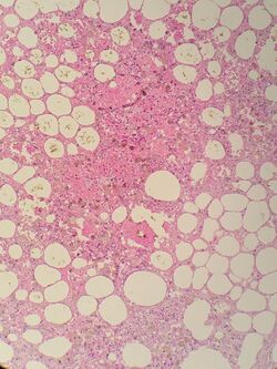 Sclerosing Mesenteritis Histology.jpg