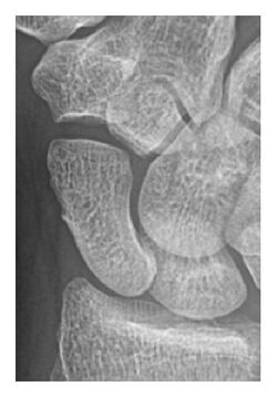 X-ray of occult scaphoid fracture.jpg