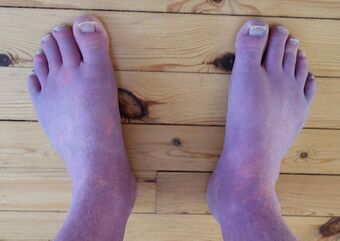 Acrocyanosis in a male Norwegian POTS patient. The patient's legs appear red and purple due to the condition.