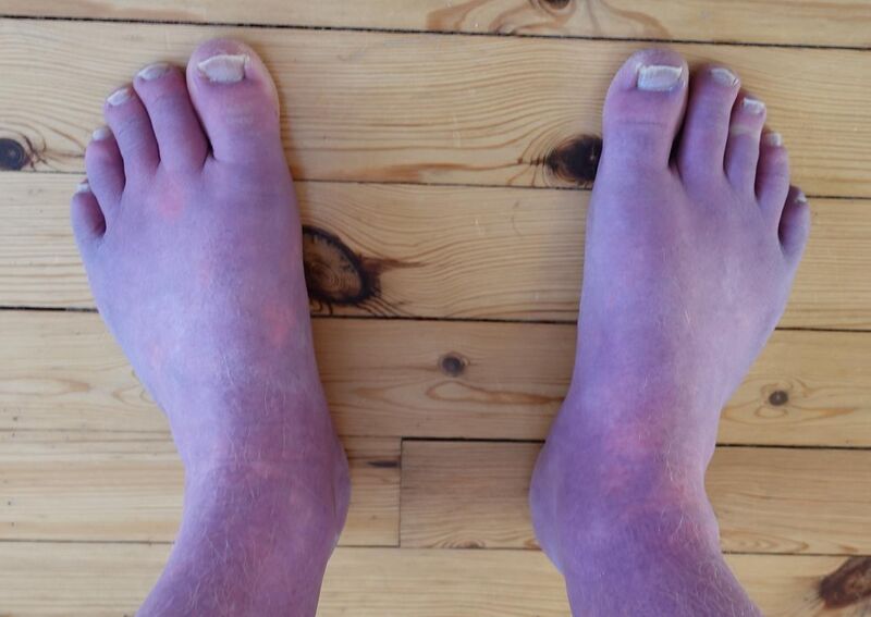 File:Dependent Acrocyanosis in a Norwegian 33-year old male POTS patient.jpg