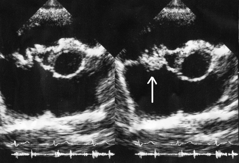 File:Endocarditis ultrasound.gif