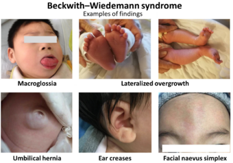 Examples of findings in Beckwith–Wiedemann syndrome.png