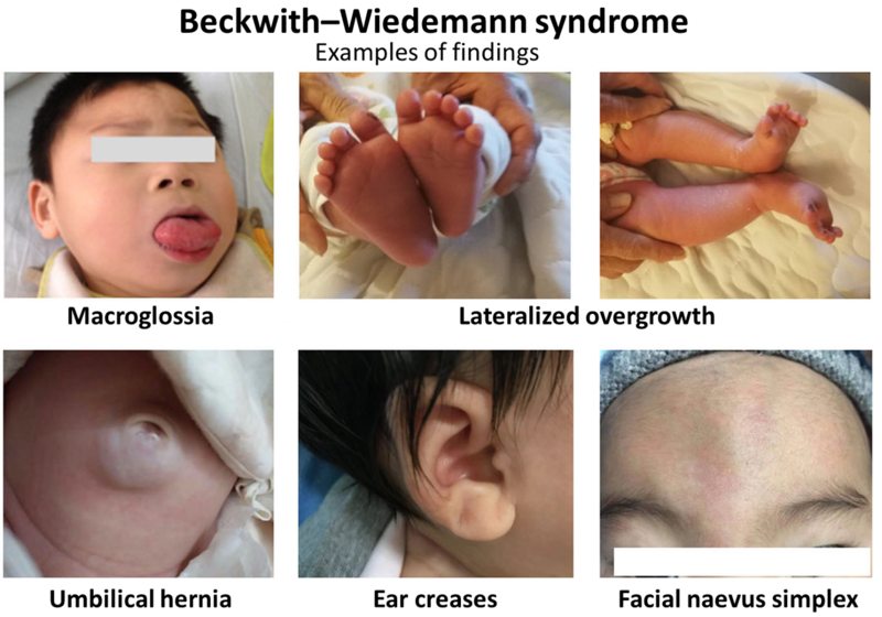 File:Examples of findings in Beckwith–Wiedemann syndrome.png