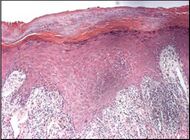 Histopathology of lichen planus.jpg