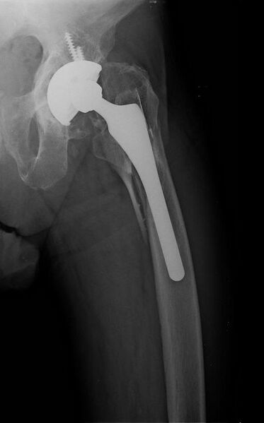 File:Periprosthetic fracture of left femur, case 1, before treatment.jpg
