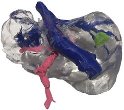 3D printed liver model for decision making.jpg