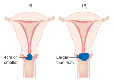 File:Diagram showing stage 1B cervical cancer CRUK 203.svg