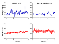 Examples of heart rate and QT interval variability.