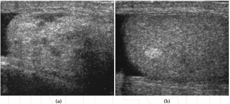 File:Scrotal ultrasonography of lipoma.jpg
