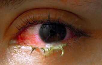 Swollen eye with conjunctivitis.jpg