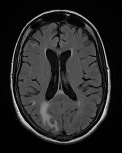 BrainToxoplasmosis MRI 2 09.png
