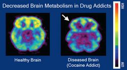 Brain metabolism and drug addiction.jpg