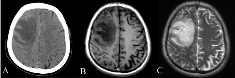 File:CT and MRI scan of the brain with melioidosis.jpg