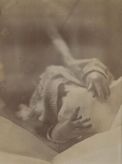 Hands of a baby affected with tetany Wellcome L0067011.jpg