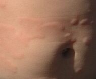 Urticaria near navel.jpg