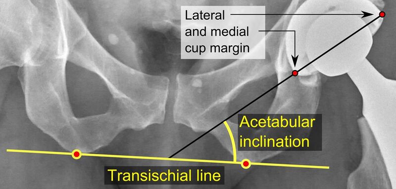 File:Acetabular inclination of hip prosthesis.jpg