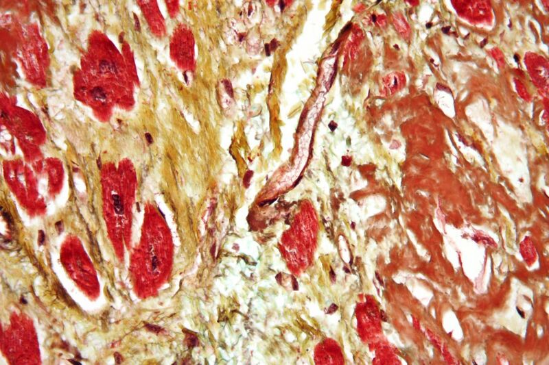 File:Cardiac amyloidosis very high mag movat.jpg
