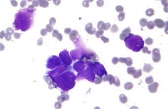 Small cell lung cancer - cytology.jpg