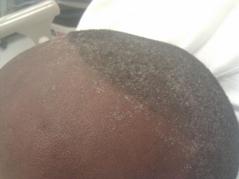 File:Uremic frost on forehead and scalp of young Afro-Caribbean male.jpg