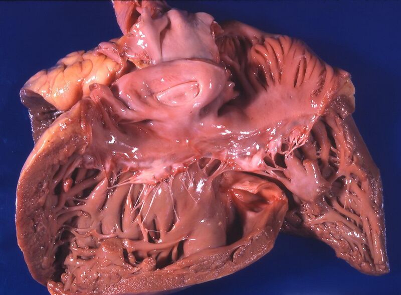 File:Heart - cor pulmonale- right ventricular hypertrophy (4351912426).jpg