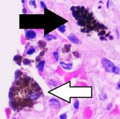 Histopathology of anthracotic macrophage in lung, annotated.jpg