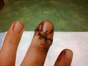 Near-amputated finger tip with stitches 2.jpg