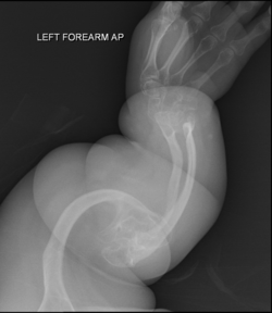 Osteogenesis imperfecta X-ray (clinically type IV) of left forearm.png