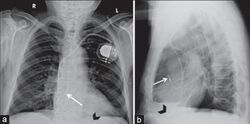 X-ray of pacemaker with right atrial and ventricular lead.jpg