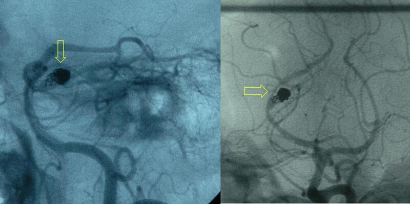File:Coiled PCA residual aneurysm arteriogram.JPG
