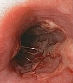 Herpes esophagitis.JPG