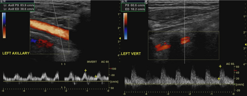 File:Ultrasound of Left Subclavian Steal Syndrome.PNG