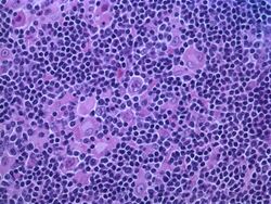 Hodgkin lymphoma, nodular lymphocyte predominant - high power view - H&E - by Gabriel Caponetti.jpg