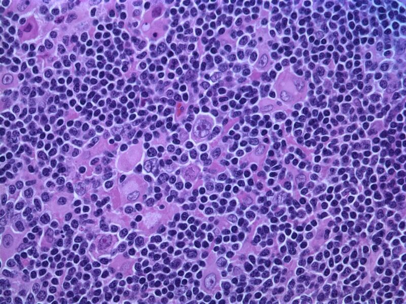File:Hodgkin lymphoma, nodular lymphocyte predominant - high power view - H&E - by Gabriel Caponetti.jpg