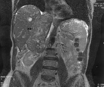Leiomyosarcoma of the Adrenal vein 1.jpg