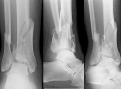 Pilon fracture xray.jpg