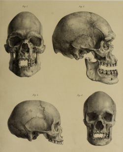 Photograph of three skulls in front and side view, used by Sir William Turner to racially define Aboriginal Australians