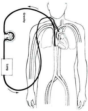 Veno-arterial (VA) ECMO for cardiac or respiratory failure.jpg
