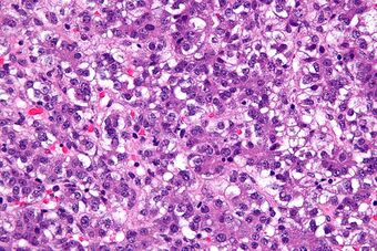 Hepatoblastoma - 2 - very high mag.jpg