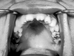 Hutchinson teeth congenital syphilis PHIL 2385.rsh.jpg