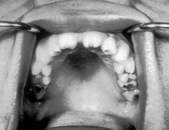 Hutchinson teeth congenital syphilis PHIL 2385.rsh.jpg