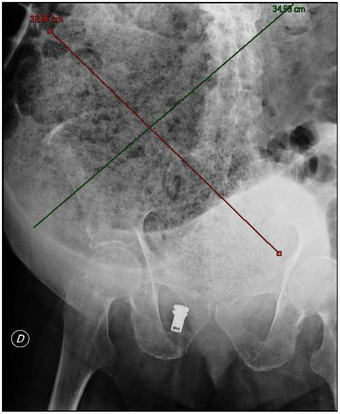 Journal.pmed.1000092.g002 fecal impaction.png