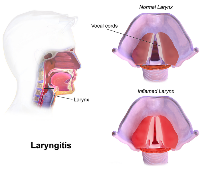 File:Laryngitis.png