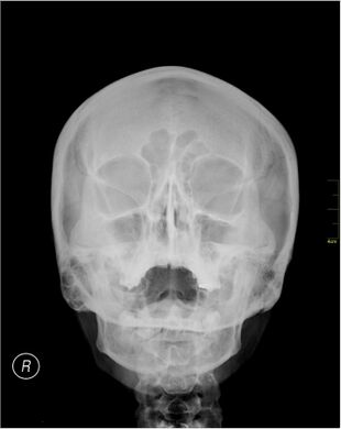 Medical X-Ray imaging PZJ06 nevit.jpg