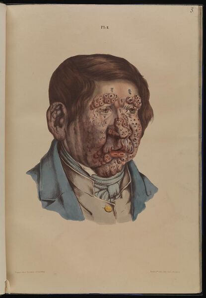 File:13 year old boy with severe leprosy Wellcome L0074842.jpg