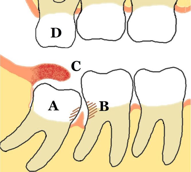 File:Lower mandibular third molar impaction pericoronitis diagram.jpg
