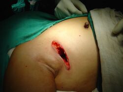 Lumpectomy 02.jpg