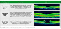 Classification of Vitreomacular Adhesion, Traction, and Macular Hole (IVTS 2013).jpg